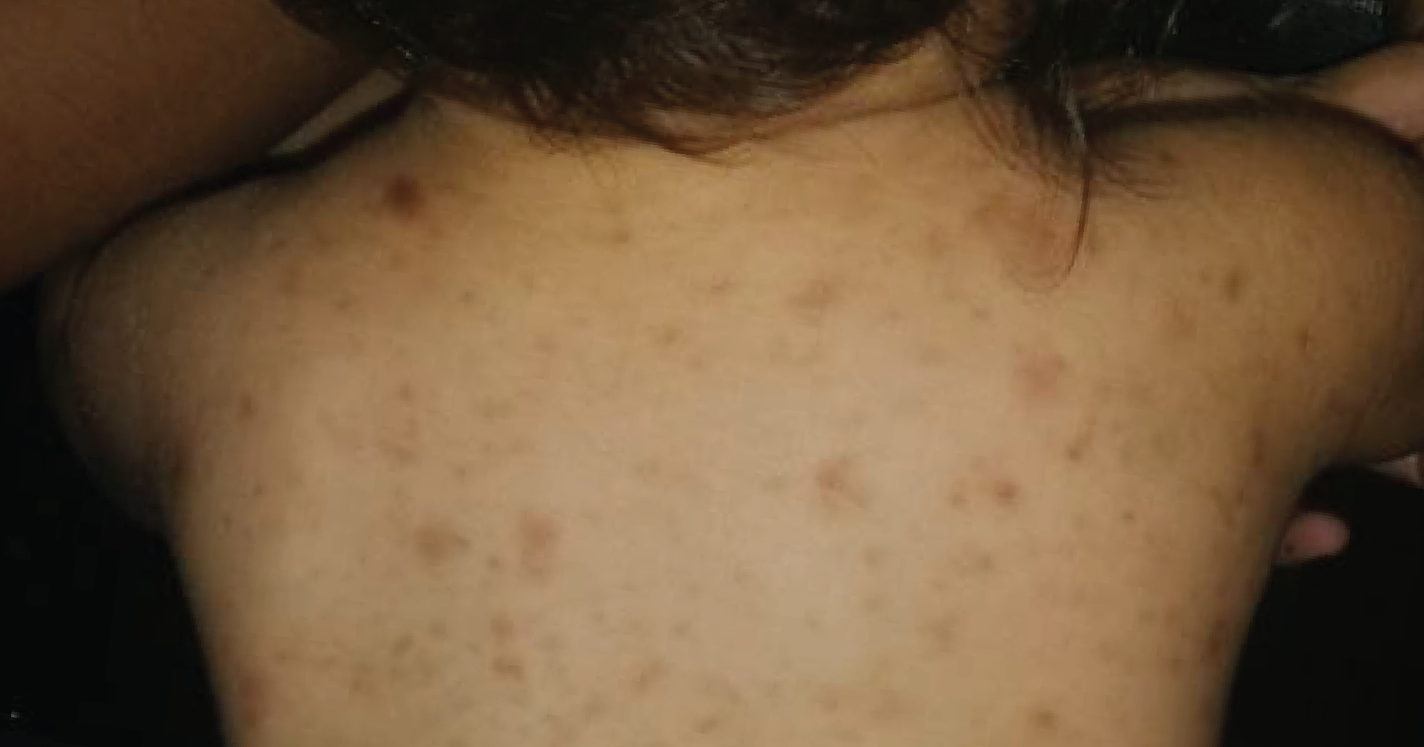 Serria Rash Urticaria pigmentosa in a 9-month-old male: case report